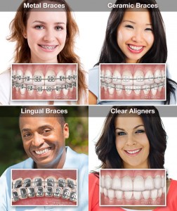 types-of-braces